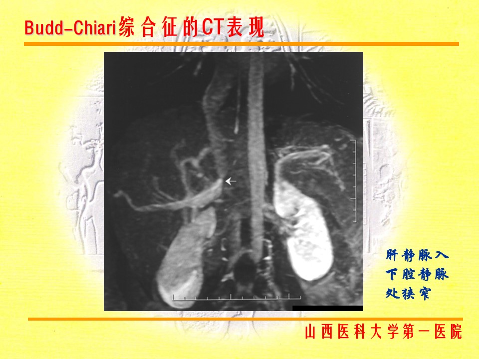 布加综合征CT表现