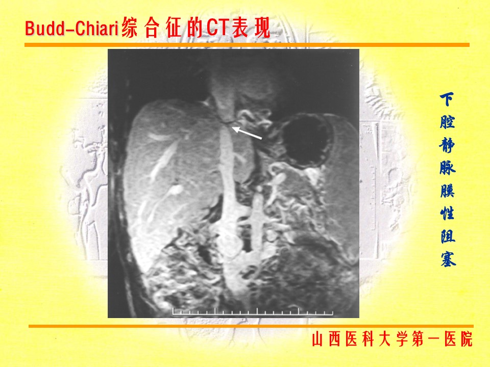 布加综合征CT表现