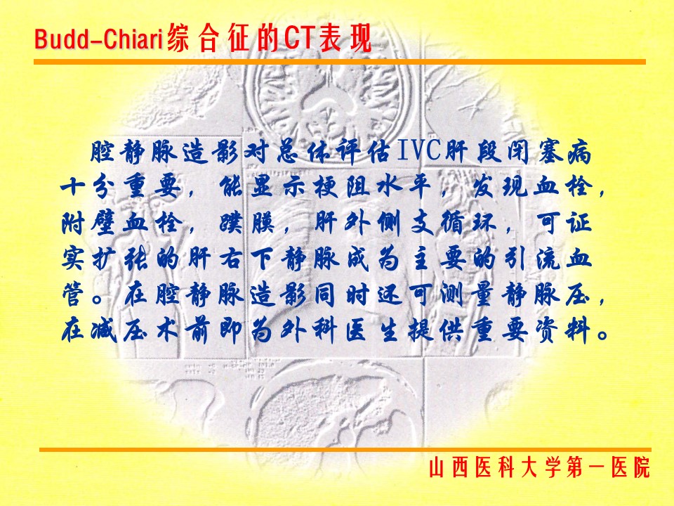 布加综合征CT表现