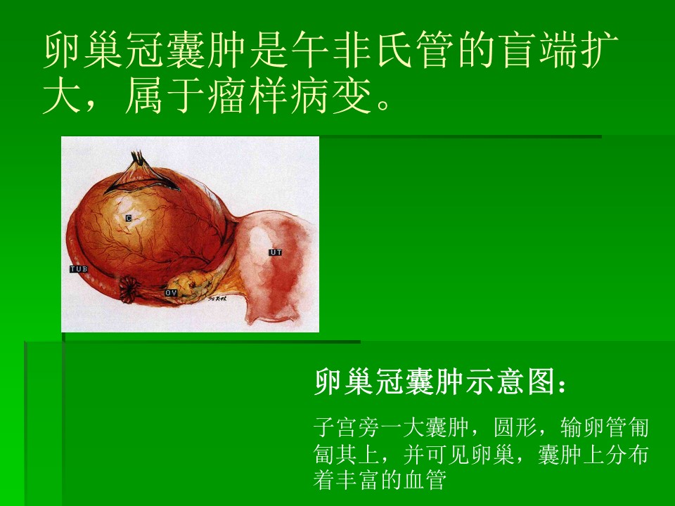 【PPT】卵巢冠囊肿