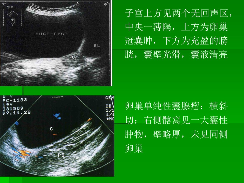【PPT】卵巢冠囊肿