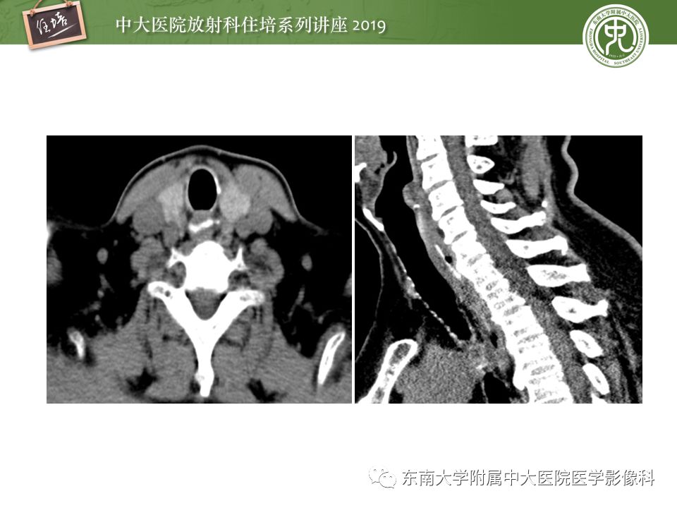 【PPT】食管常见疾病的诊断和鉴别诊断