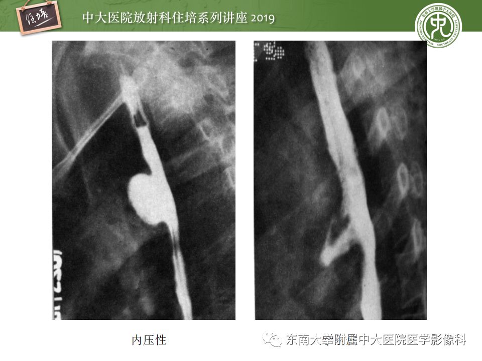 【PPT】食管常见疾病的诊断和鉴别诊断