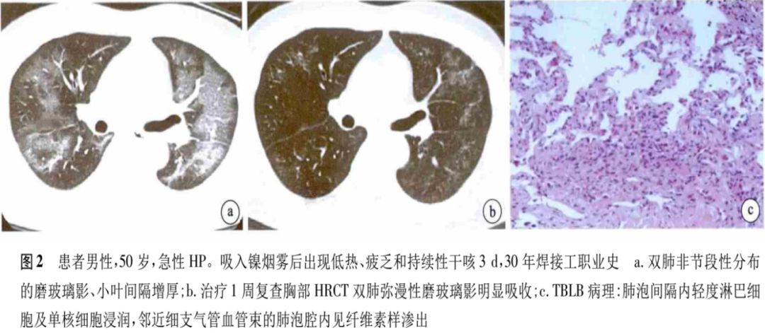 过敏性肺炎—这个疾病易与病毒性肺炎混淆,鉴别诊断不可不知 过敏性肺炎—这个疾病易与病毒性肺炎混淆,鉴别诊断不可不知