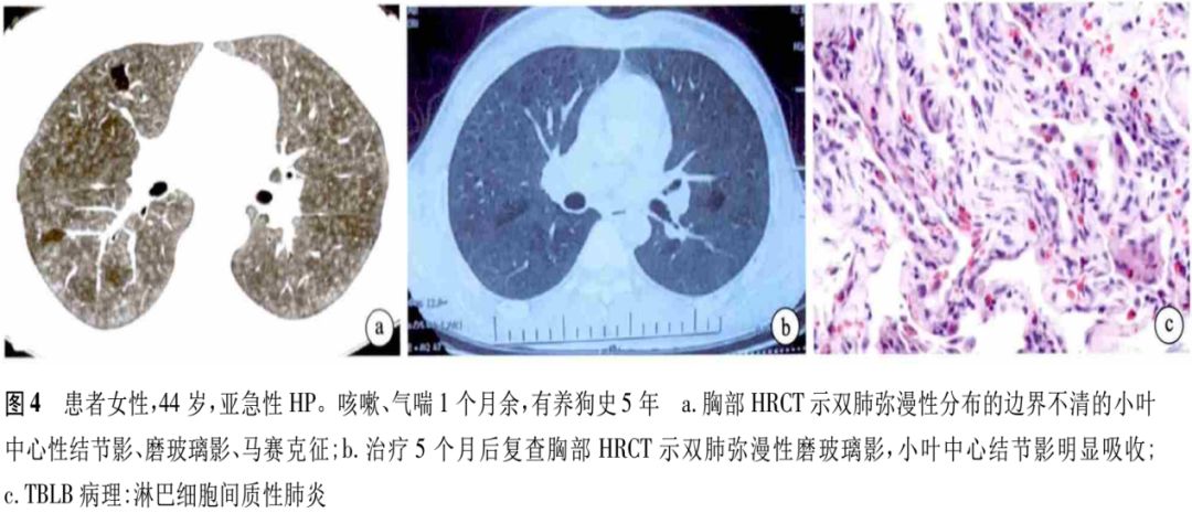 过敏性肺炎—这个疾病易与病毒性肺炎混淆,鉴别诊断不可不知 过敏性肺炎—这个疾病易与病毒性肺炎混淆,鉴别诊断不可不知