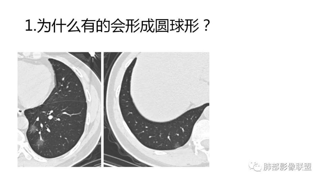 【PPT】南边团队180例NCP新型冠状病毒肺炎总结