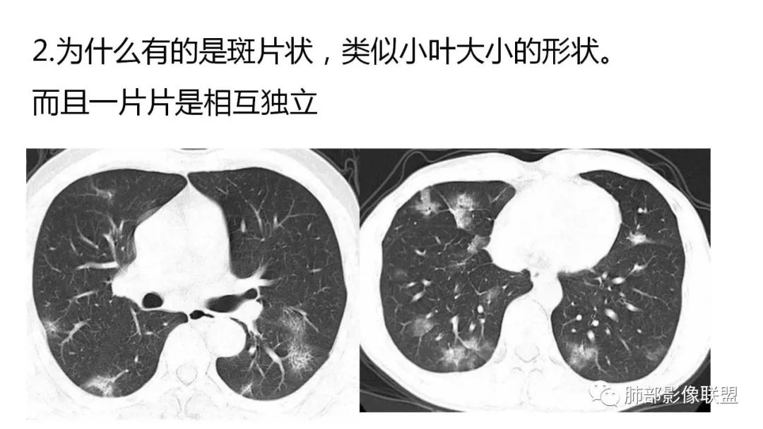 【PPT】南边团队180例NCP新型冠状病毒肺炎总结