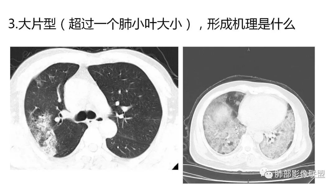 【PPT】南边团队180例NCP新型冠状病毒肺炎总结