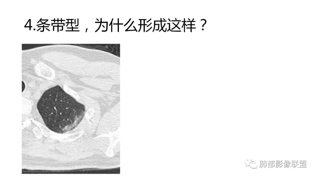 【PPT】南边团队180例NCP新型冠状病毒肺炎总结