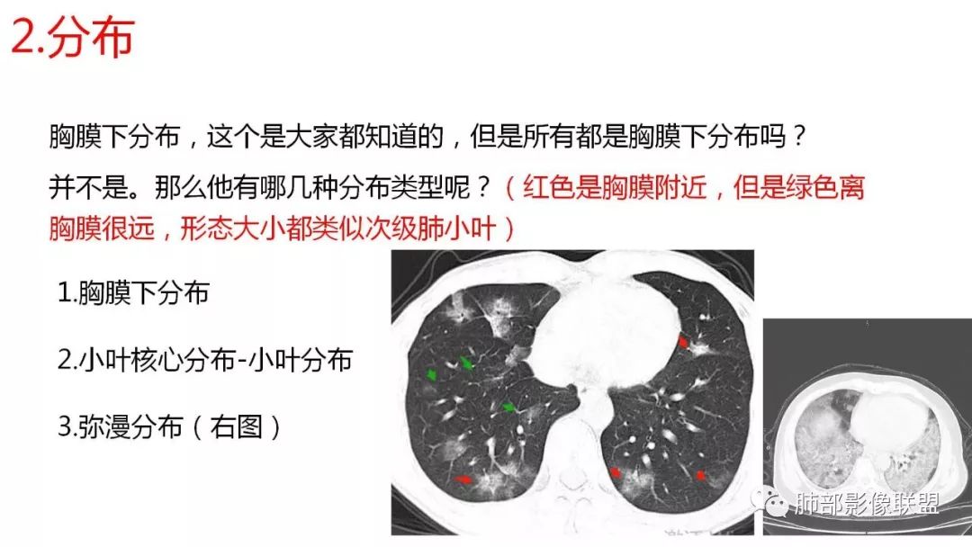 【PPT】南边团队180例NCP新型冠状病毒肺炎总结