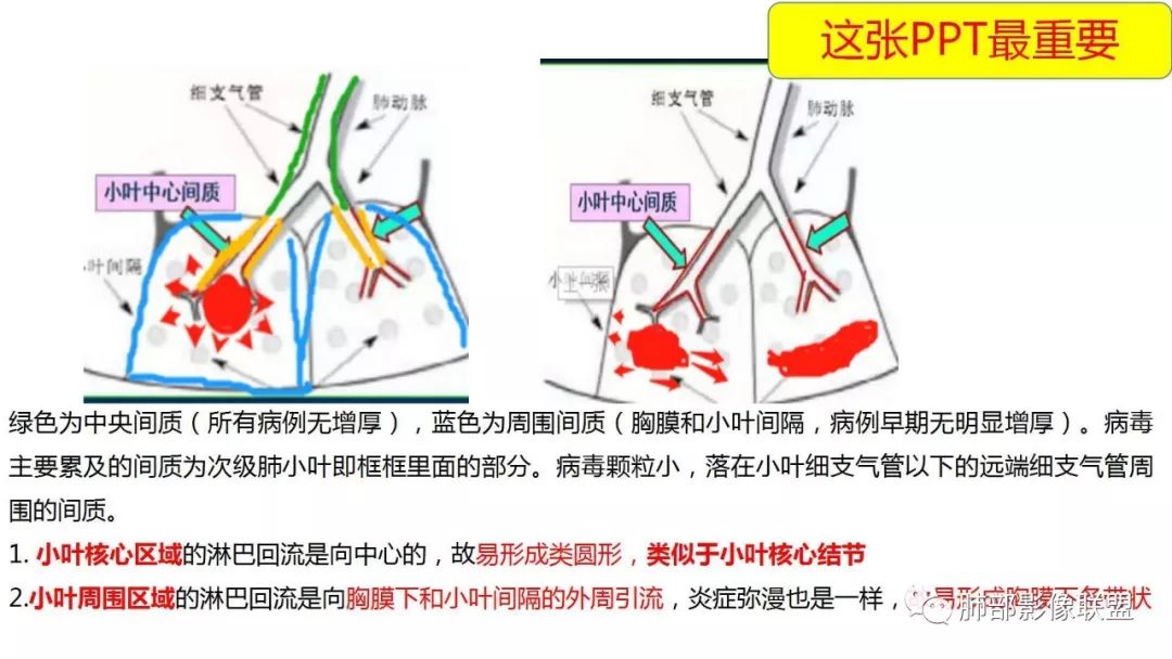 【PPT】南边团队180例NCP新型冠状病毒肺炎总结