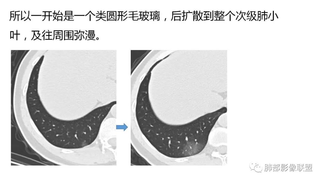 【PPT】南边团队180例NCP新型冠状病毒肺炎总结