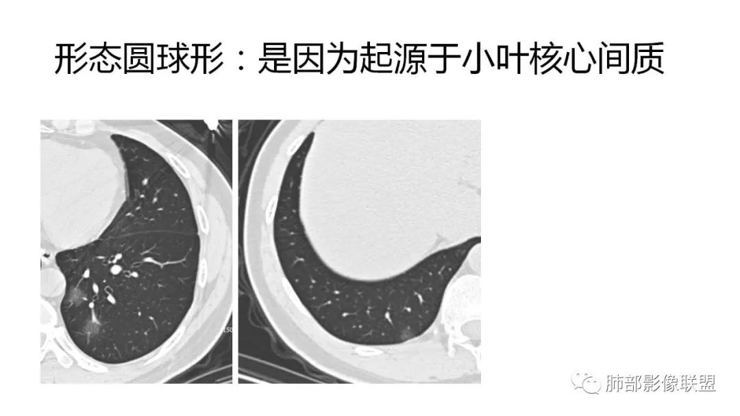 【PPT】南边团队180例NCP新型冠状病毒肺炎总结