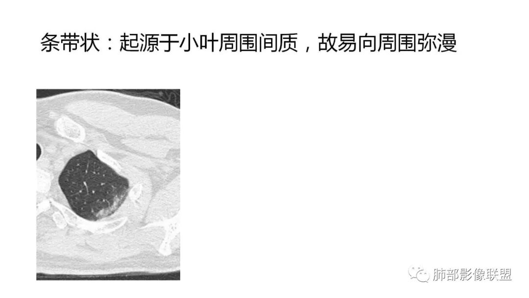【PPT】南边团队180例NCP新型冠状病毒肺炎总结