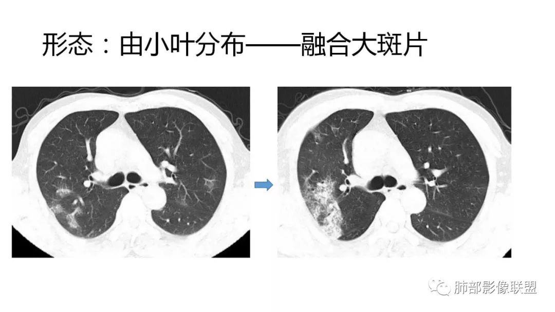 【PPT】南边团队180例NCP新型冠状病毒肺炎总结