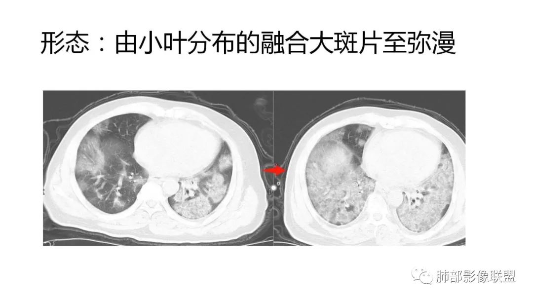 【PPT】南边团队180例NCP新型冠状病毒肺炎总结