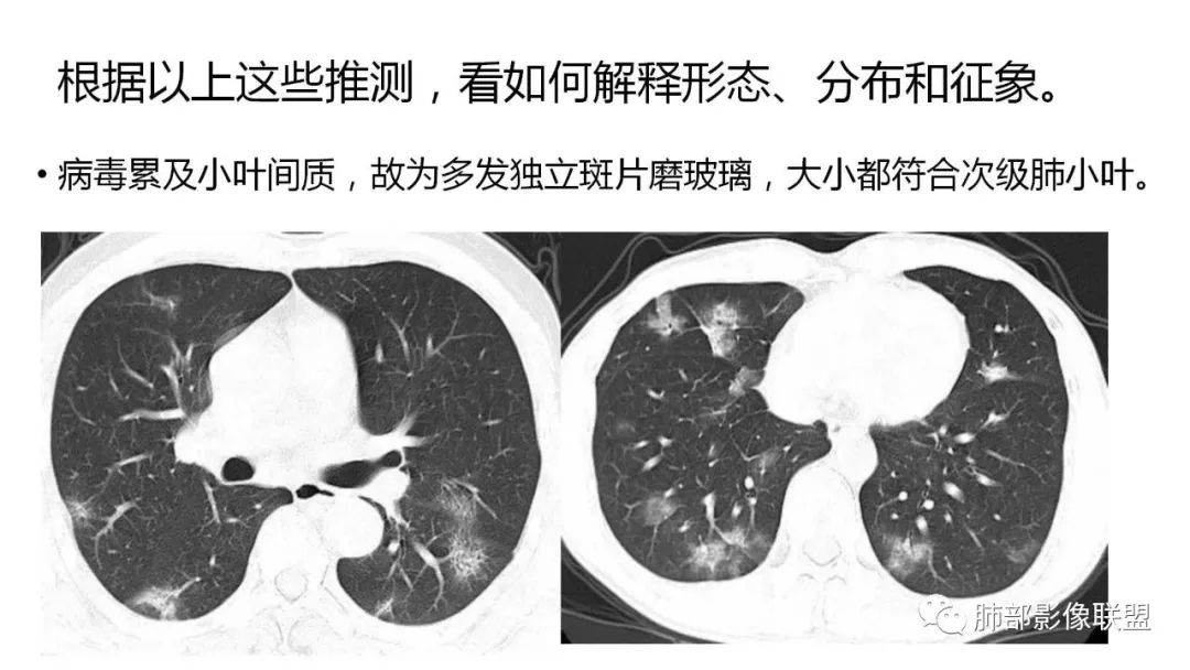 【PPT】南边团队180例NCP新型冠状病毒肺炎总结