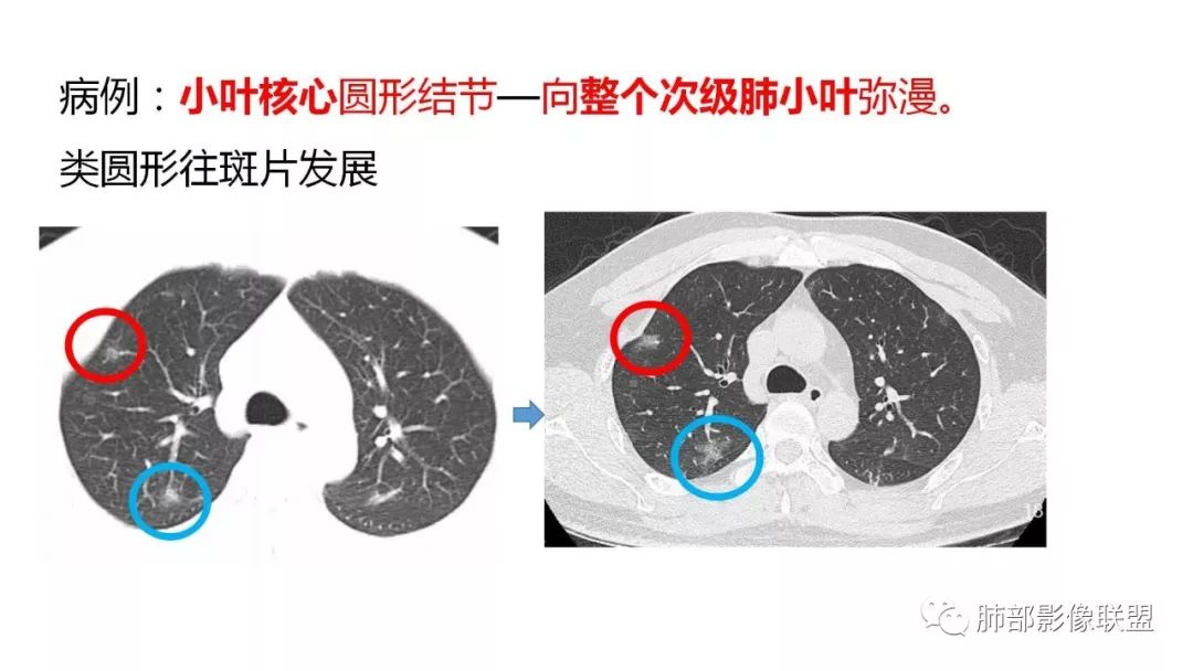 【PPT】南边团队180例NCP新型冠状病毒肺炎总结