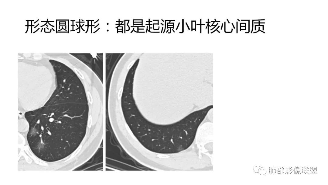 【PPT】南边团队180例NCP新型冠状病毒肺炎总结
