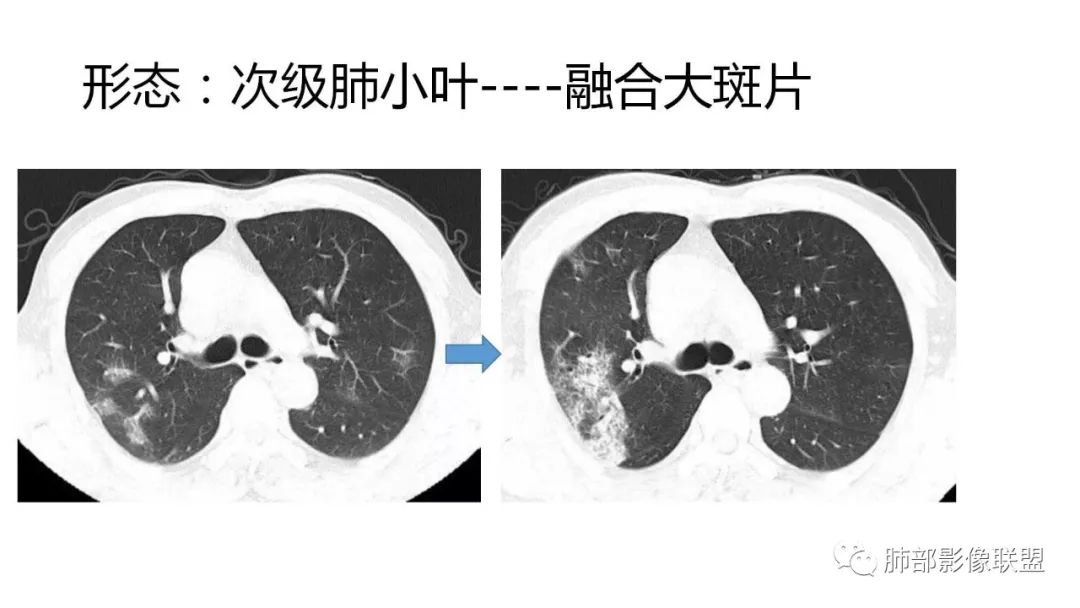 【PPT】南边团队180例NCP新型冠状病毒肺炎总结