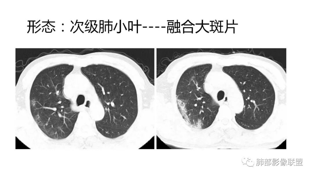 【PPT】南边团队180例NCP新型冠状病毒肺炎总结