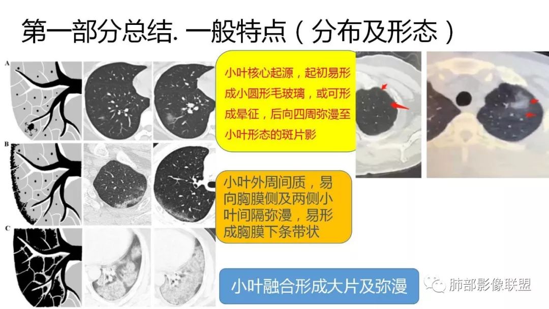 【PPT】南边团队180例NCP新型冠状病毒肺炎总结