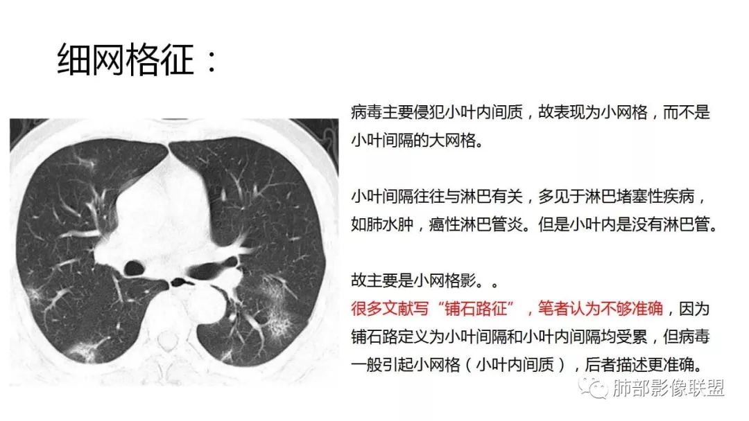 【PPT】南边团队180例NCP新型冠状病毒肺炎总结