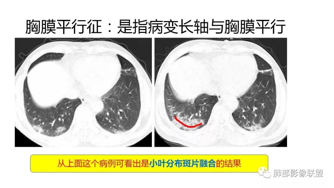 【PPT】南边团队180例NCP新型冠状病毒肺炎总结
