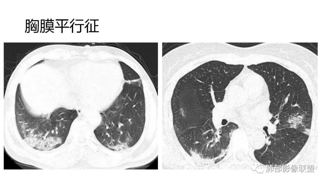 【PPT】南边团队180例NCP新型冠状病毒肺炎总结