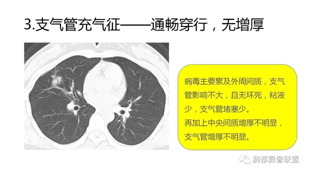 【PPT】南边团队180例NCP新型冠状病毒肺炎总结