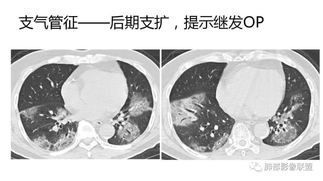 【PPT】南边团队180例NCP新型冠状病毒肺炎总结