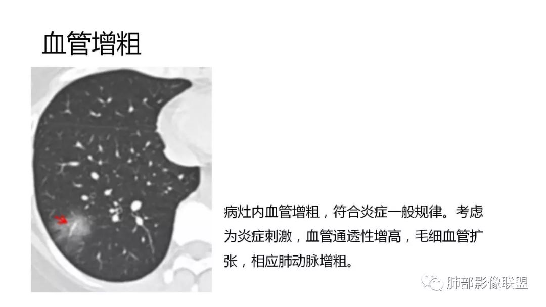 【PPT】南边团队180例NCP新型冠状病毒肺炎总结