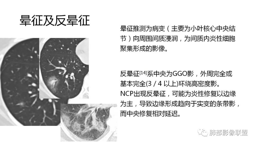 【PPT】南边团队180例NCP新型冠状病毒肺炎总结