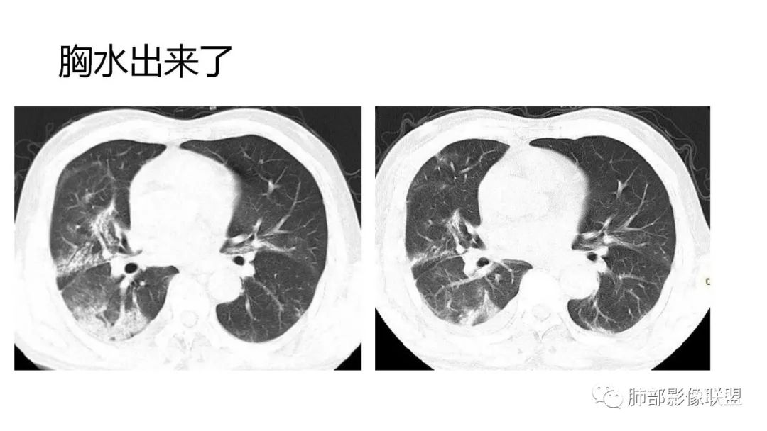 【PPT】南边团队180例NCP新型冠状病毒肺炎总结