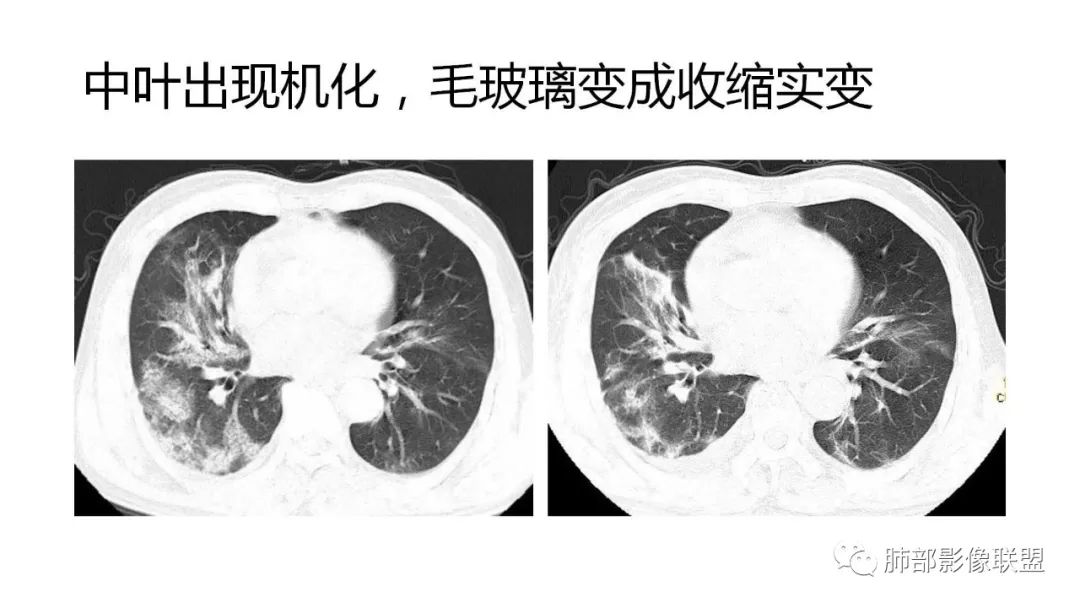【PPT】南边团队180例NCP新型冠状病毒肺炎总结