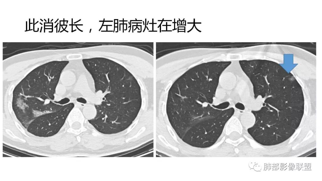 【PPT】南边团队180例NCP新型冠状病毒肺炎总结