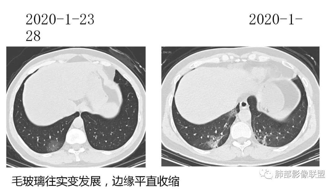 【PPT】南边团队180例NCP新型冠状病毒肺炎总结