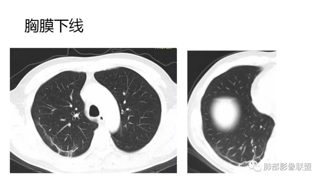 【PPT】南边团队180例NCP新型冠状病毒肺炎总结
