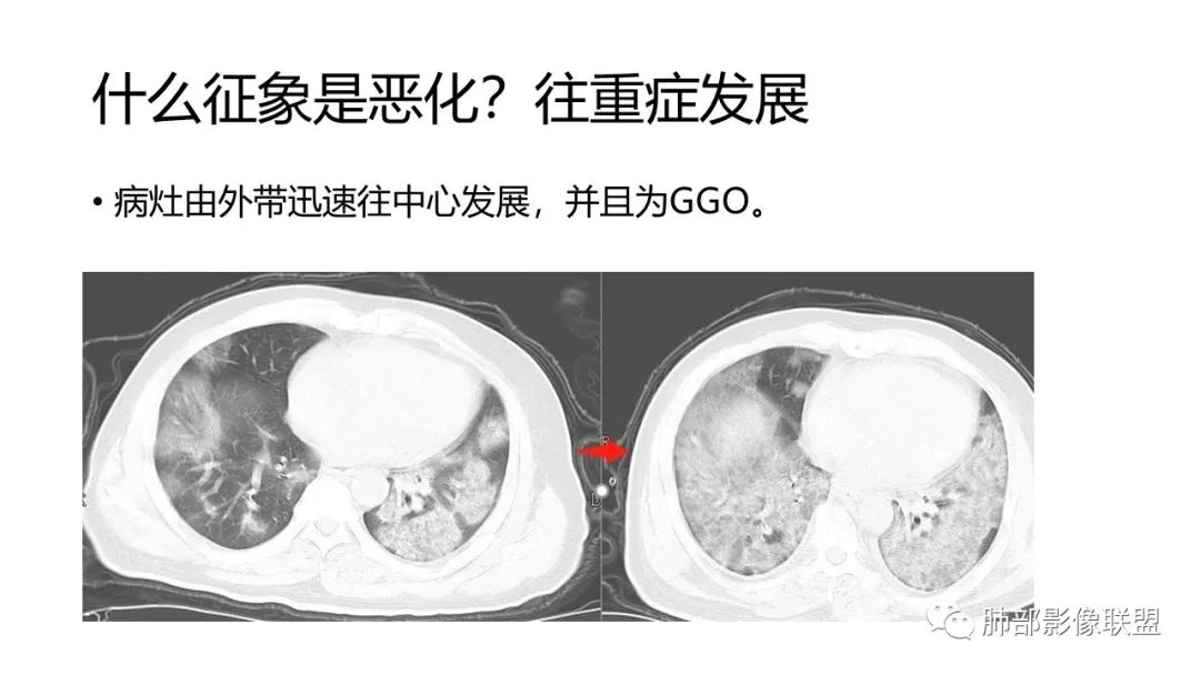 【PPT】南边团队180例NCP新型冠状病毒肺炎总结