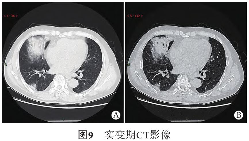 新冠肺炎的CT典型和不典型表现以及影像学分期