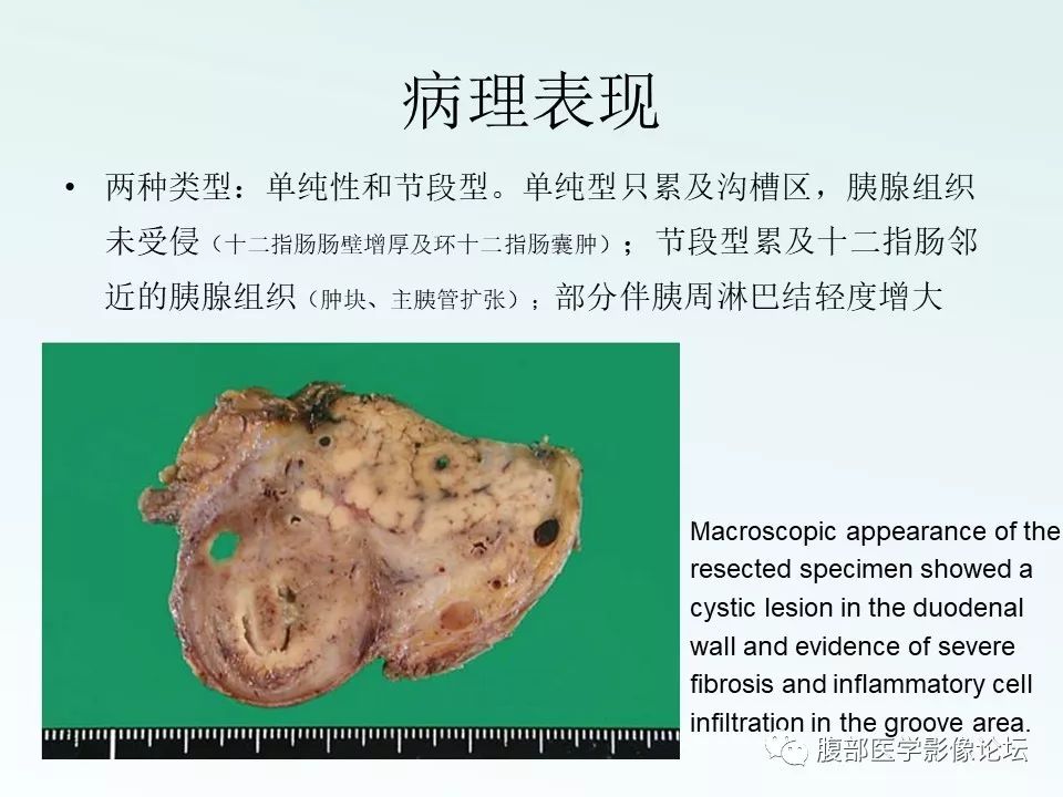 【PPT】沟槽性胰腺炎 【PPT】沟槽性胰腺炎