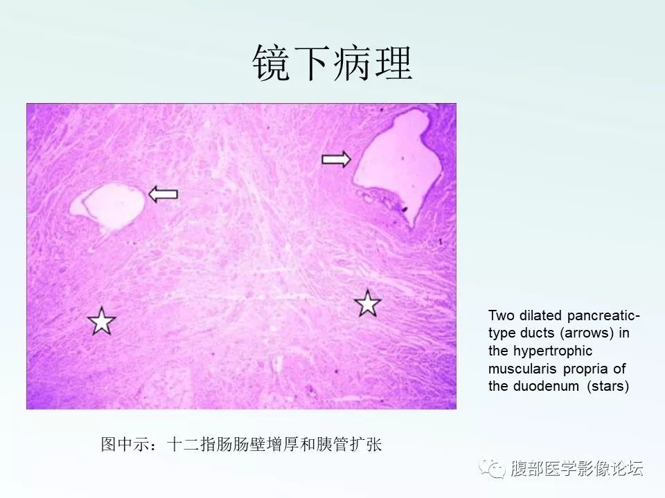 【PPT】沟槽性胰腺炎 【PPT】沟槽性胰腺炎