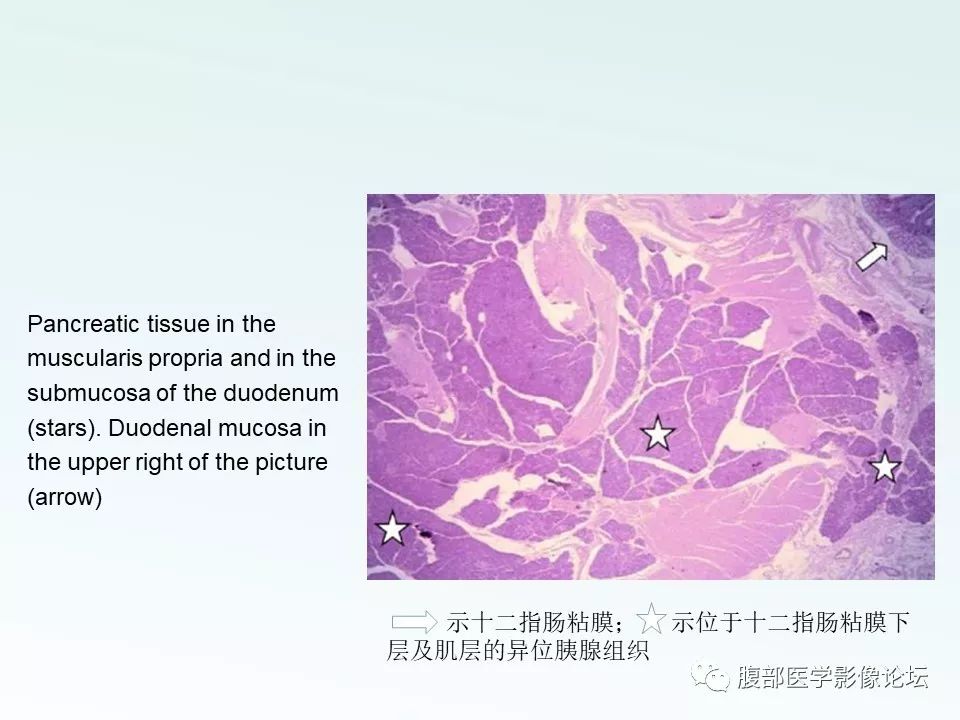 【PPT】沟槽性胰腺炎 【PPT】沟槽性胰腺炎