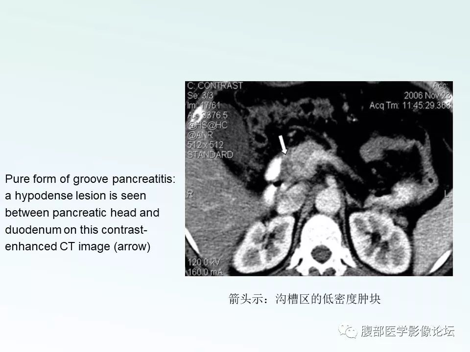 【PPT】沟槽性胰腺炎 【PPT】沟槽性胰腺炎