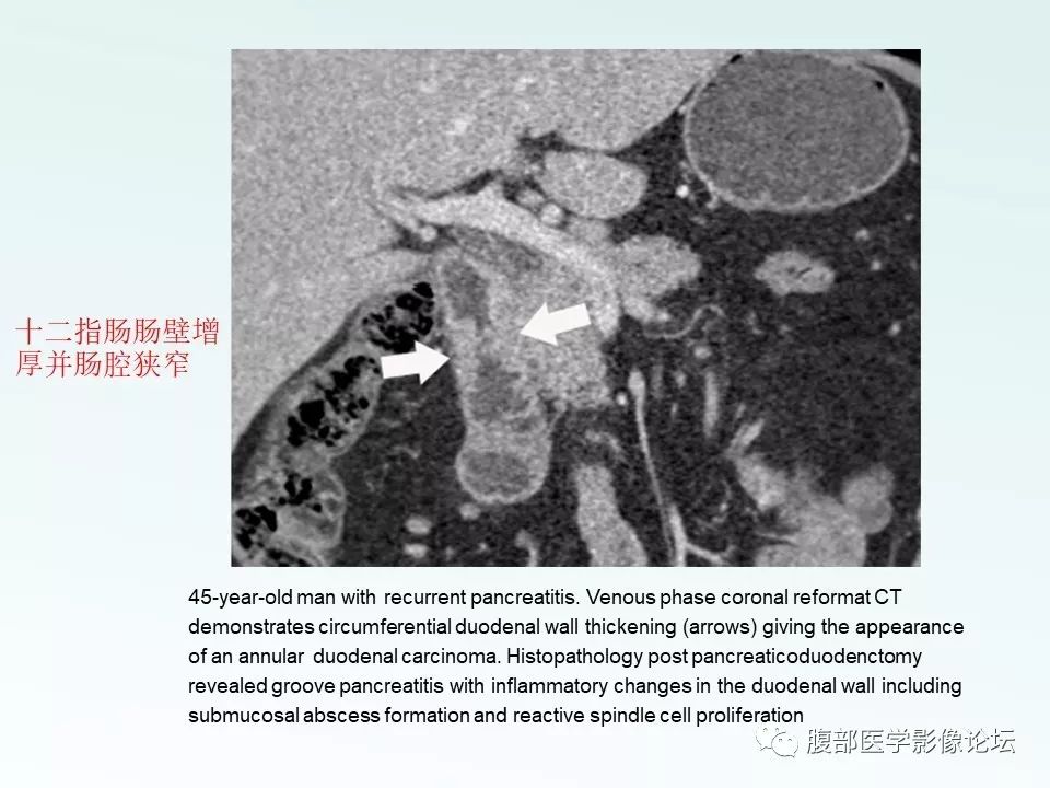 【PPT】沟槽性胰腺炎 【PPT】沟槽性胰腺炎