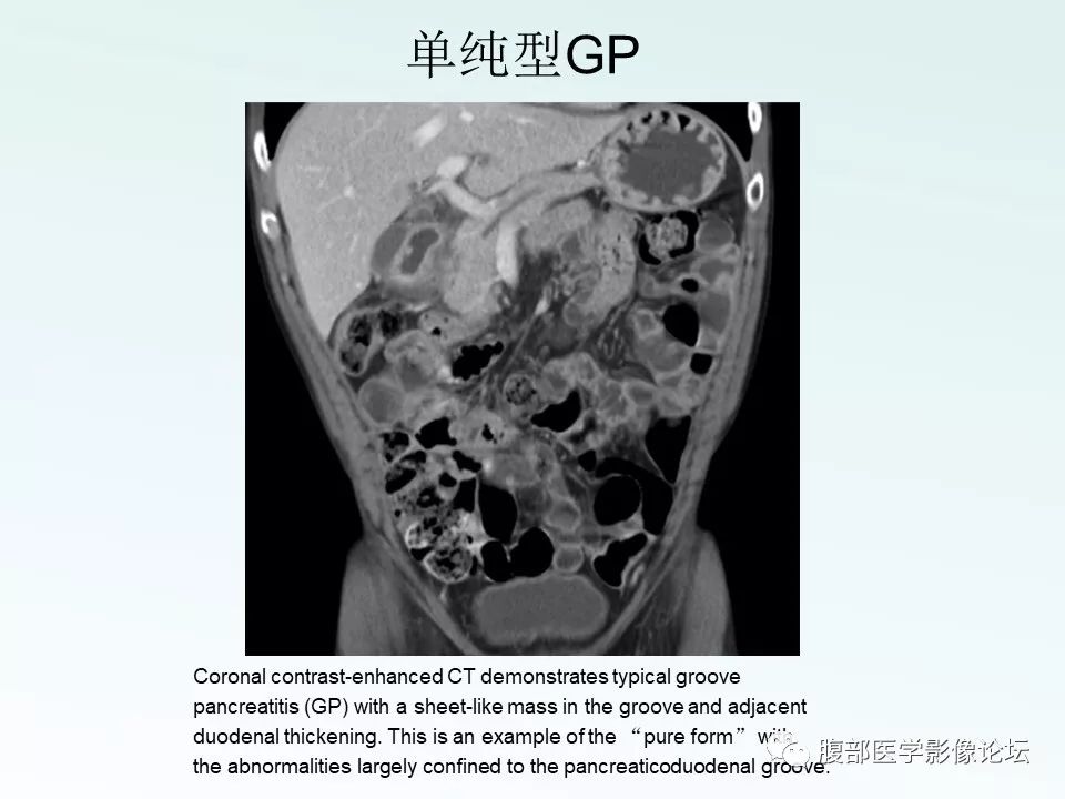 【PPT】沟槽性胰腺炎 【PPT】沟槽性胰腺炎