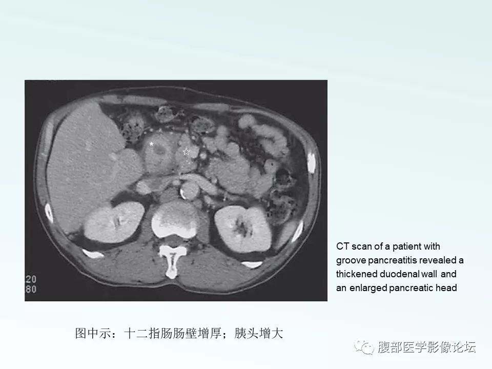 【PPT】沟槽性胰腺炎 【PPT】沟槽性胰腺炎