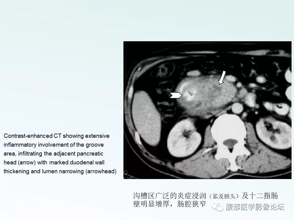 【PPT】沟槽性胰腺炎 【PPT】沟槽性胰腺炎