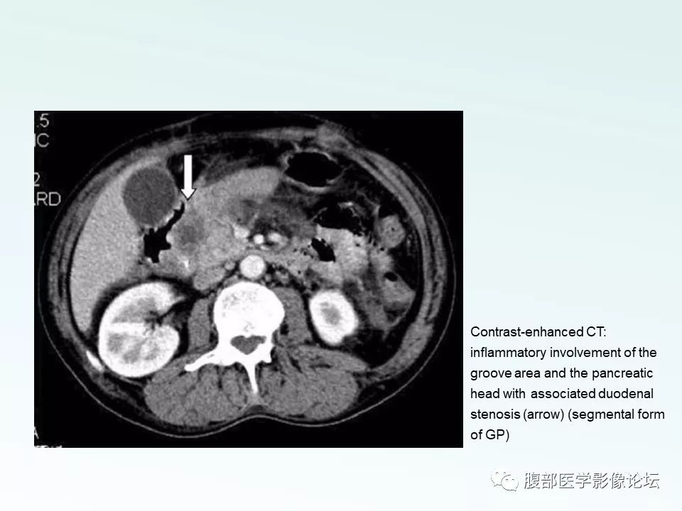 【PPT】沟槽性胰腺炎 【PPT】沟槽性胰腺炎