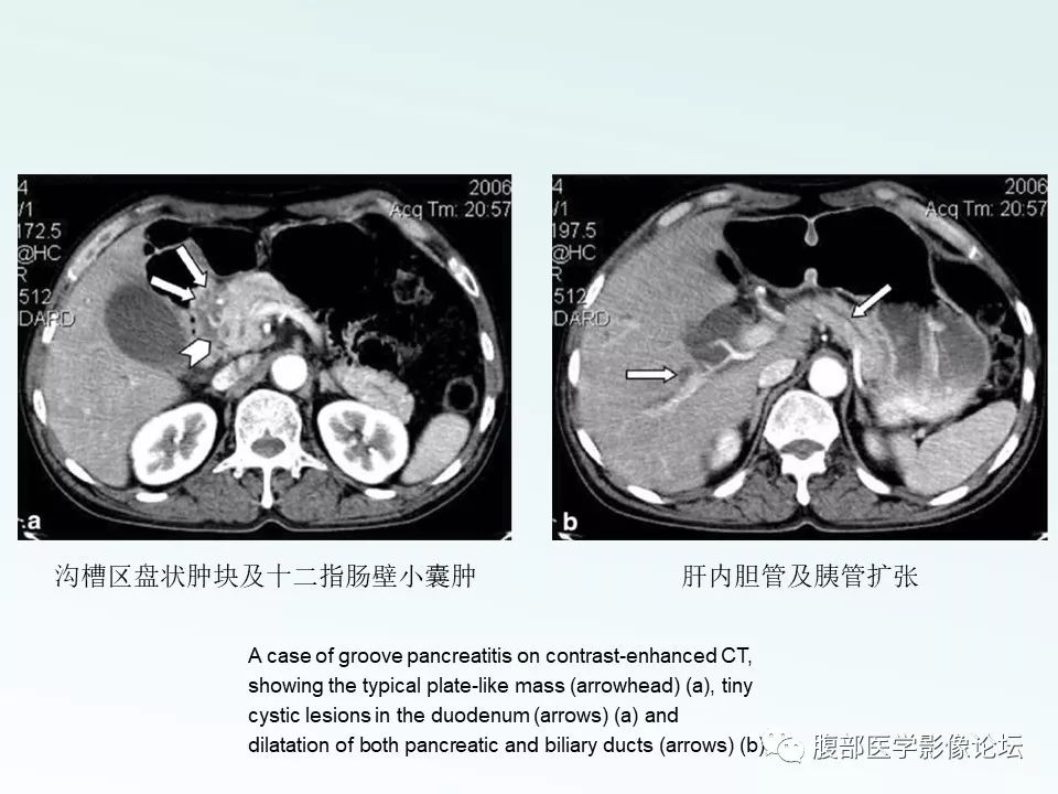 【PPT】沟槽性胰腺炎 【PPT】沟槽性胰腺炎